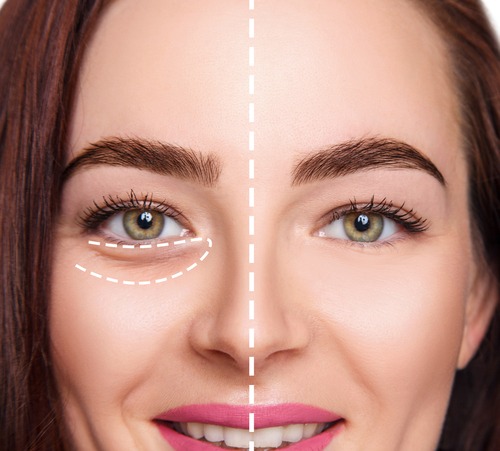 Get Rid Of Eye Bags Without Surgery